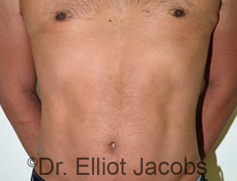 Male body, after Torsoplasty treatment, front view, patient 26
