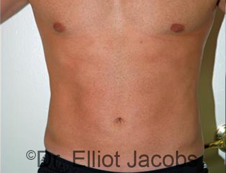 Male body, after Torsoplasty treatment, front view, patient 27