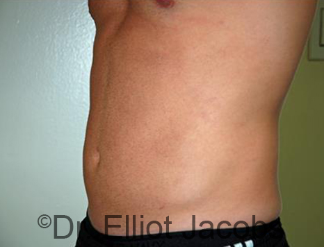 Male body, after Torsoplasty treatment, l-side oblique view, patient 27