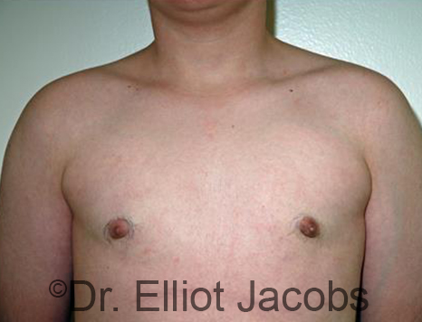 Men's breast, after Gynecomastia Adolescent treatment, front view - patient 33