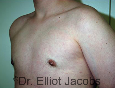 Men's breast, after Gynecomastia Adolescent treatment, oblique view - patient 33