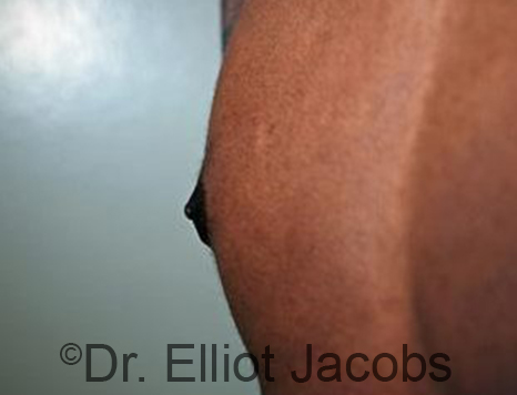 Male nipple, after Puffy Nipple treatment, r-side oblique view - patient 29