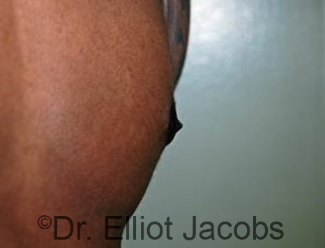 Male nipple, after Puffy Nipple treatment, l-side oblique view - patient 29