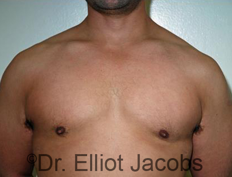 Male breast, after Gynecomastia treatment, front view, patient 89