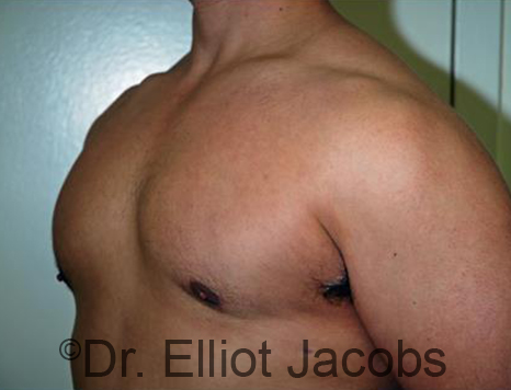 Male breast, after Gynecomastia treatment, l-side oblique view - patient 89