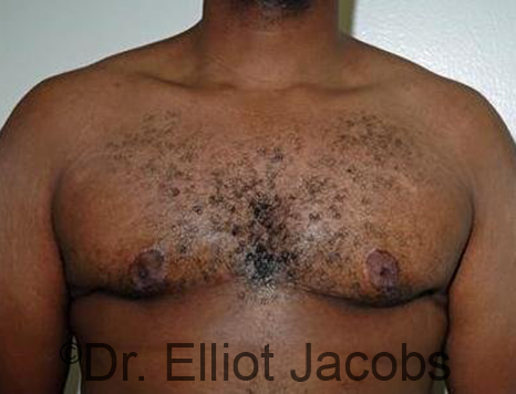 Male breast, after Gynecomastia treatment, front view, patient 90