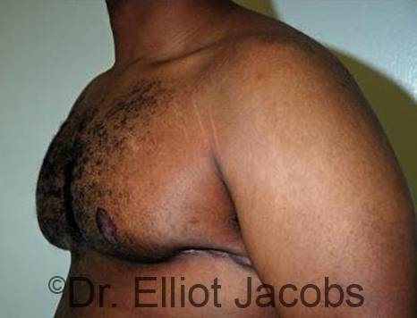 Male breast, after Gynecomastia treatment, l-side oblique view - patient 90