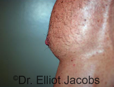 Male nipple, after Puffy Nipple treatment, oblique view - patient 47
