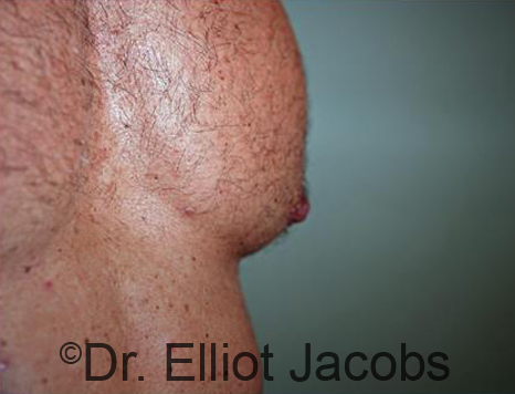 Male nipple, after Puffy Nipple treatment, side view - patient 47