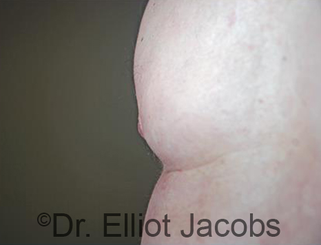 Male nipple, after Puffy Nipple treatment, oblique view - patient 49