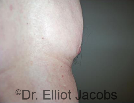 Male nipple, after Puffy Nipple treatment, side view - patient 49