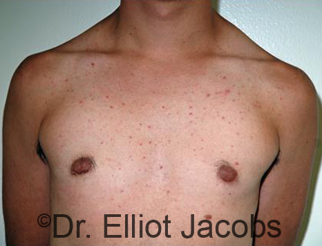 Men's breast, after Gynecomastia Adolescent treatment, front view - patient 34