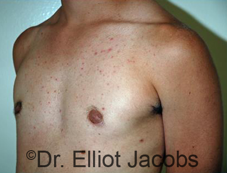 Men's breast, after Gynecomastia Adolescent treatment, oblique view - patient 34