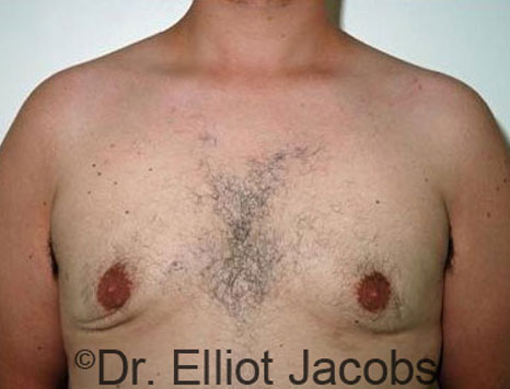 Male breast, after Gynecomastia treatment, front view, patient 25
