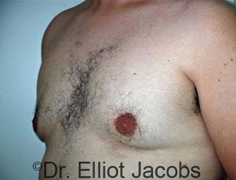 Male breast, after Gynecomastia treatment, l-side oblique view - patient 25