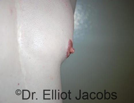 Male nipple, after Puffy Nipple treatment, l-side oblique view - patient 30