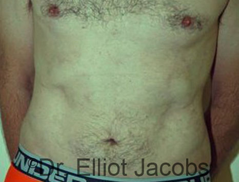 Male body, after Torsoplasty treatment, front view, patient 28