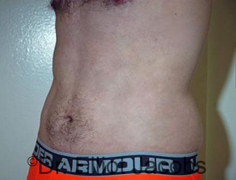 Male body, after Torsoplasty treatment, l-side oblique view, patient 28