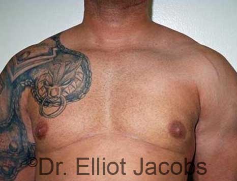 Male breast, after Gynecomastia treatment, front view, patient 91