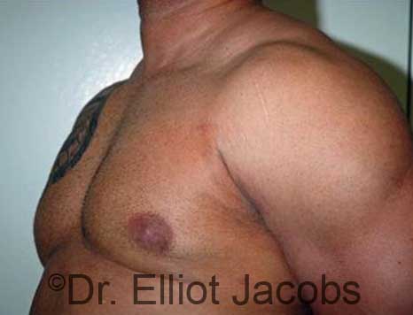 Male breast, after Gynecomastia treatment, l-side oblique view - patient 91