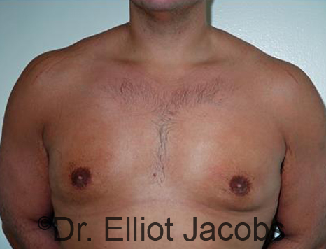 Male breast, after Gynecomastia treatment, front view, patient 92