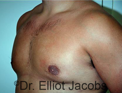 Male breast, after Gynecomastia treatment, l-side oblique view - patient 92