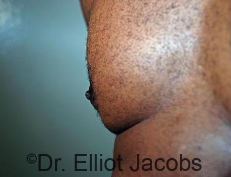 Male nipple, after Puffy Nipple treatment, r-side oblique view - patient 31