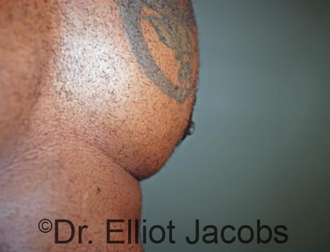 Male nipple, after Puffy Nipple treatment, l-side oblique view - patient 31