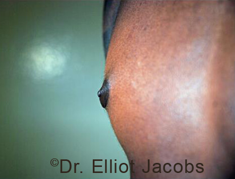 Male nipple, after Puffy Nipple treatment, oblique view - patient 50