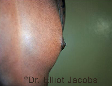 Male nipple, after Puffy Nipple treatment, side view - patient 50