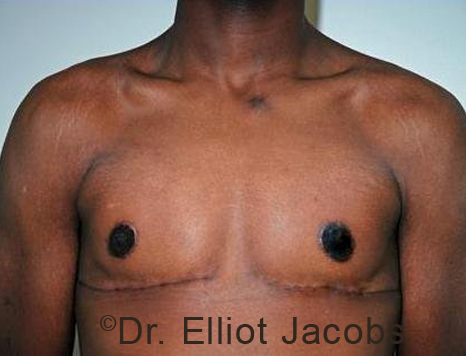 Male breast, after Gynecomastia treatment, front view, patient 93