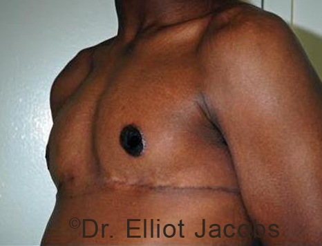 Male breast, after Gynecomastia treatment, l-side oblique view - patient 93