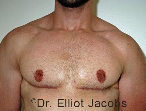 Male breast, after Gynecomastia treatment, front view, patient 94