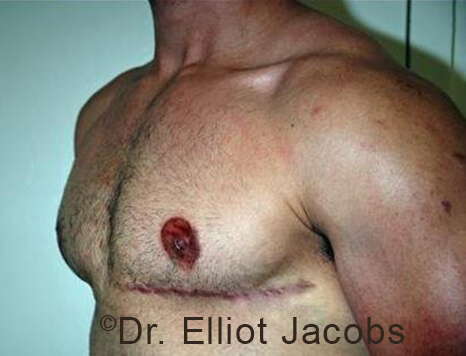 Male breast, after Gynecomastia treatment, l-side oblique view - patient 94