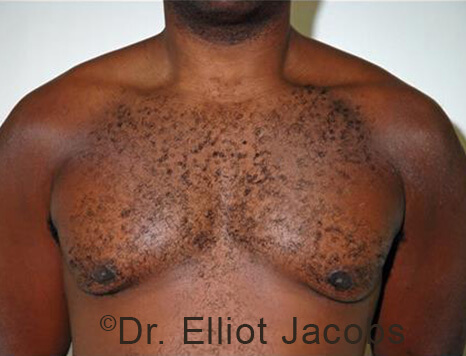 Male breast, after Gynecomastia treatment, front view, patient 95