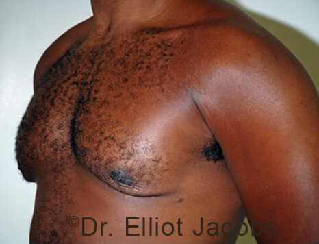 Male breast, after Gynecomastia treatment, l-side oblique view - patient 95