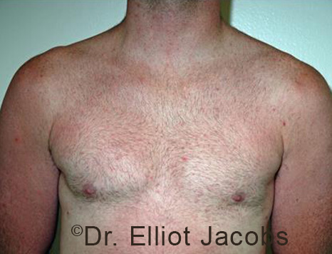 Male breast, after Gynecomastia treatment, front view, patient 96