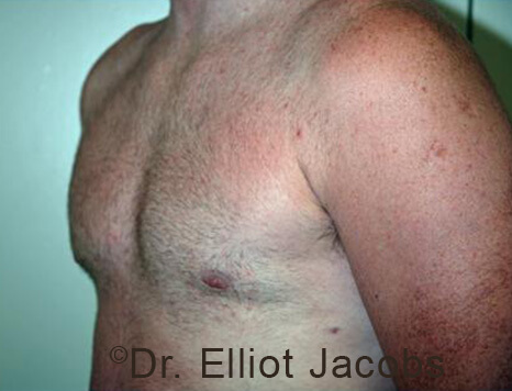 Male breast, after Gynecomastia treatment, l-side oblique view - patient 96