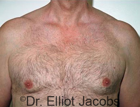 Male breast, after Gynecomastia treatment, front view, patient 26