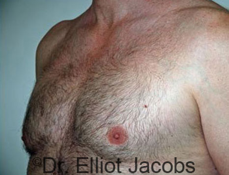 Male breast, after Gynecomastia treatment, l-side oblique view - patient 26