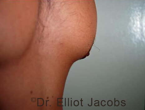 Male nipple, after Puffy Nipple treatment, r-side oblique view - patient 32
