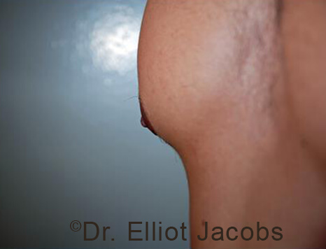 Male nipple, after Puffy Nipple treatment, l-side oblique view - patient 32