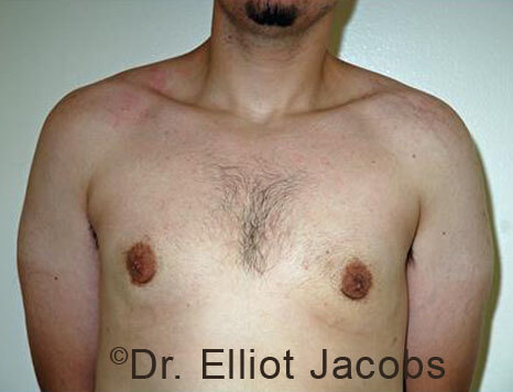 Men's breast, after Gynecomastia Adolescent treatment, front view - patient 35