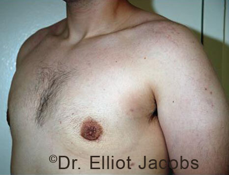 Men's breast, after Gynecomastia Adolescent treatment, oblique view - patient 35