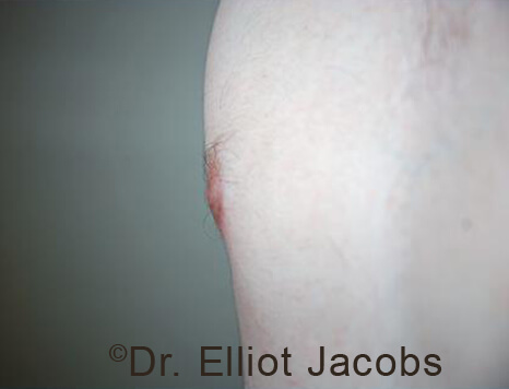 Male nipple, after Puffy Nipple treatment, r-side oblique view - patient 33