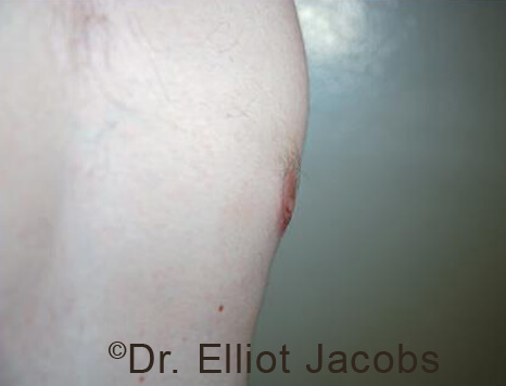 Male nipple, after Puffy Nipple treatment, l-side oblique view - patient 33