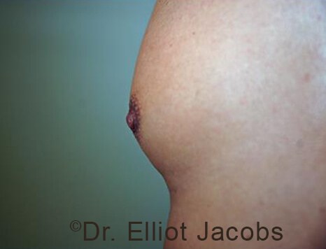 Male nipple, after Puffy Nipple treatment, oblique view - patient 51