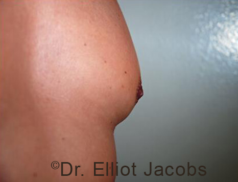 Male nipple, after Puffy Nipple treatment, side view - patient 51