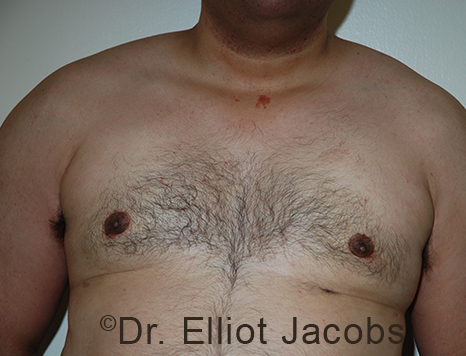 Male breast, after Gynecomastia treatment, front view, patient 97