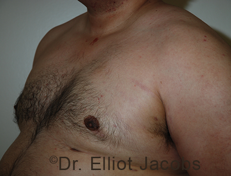 Male breast, after Gynecomastia treatment, l-side oblique view - patient 97